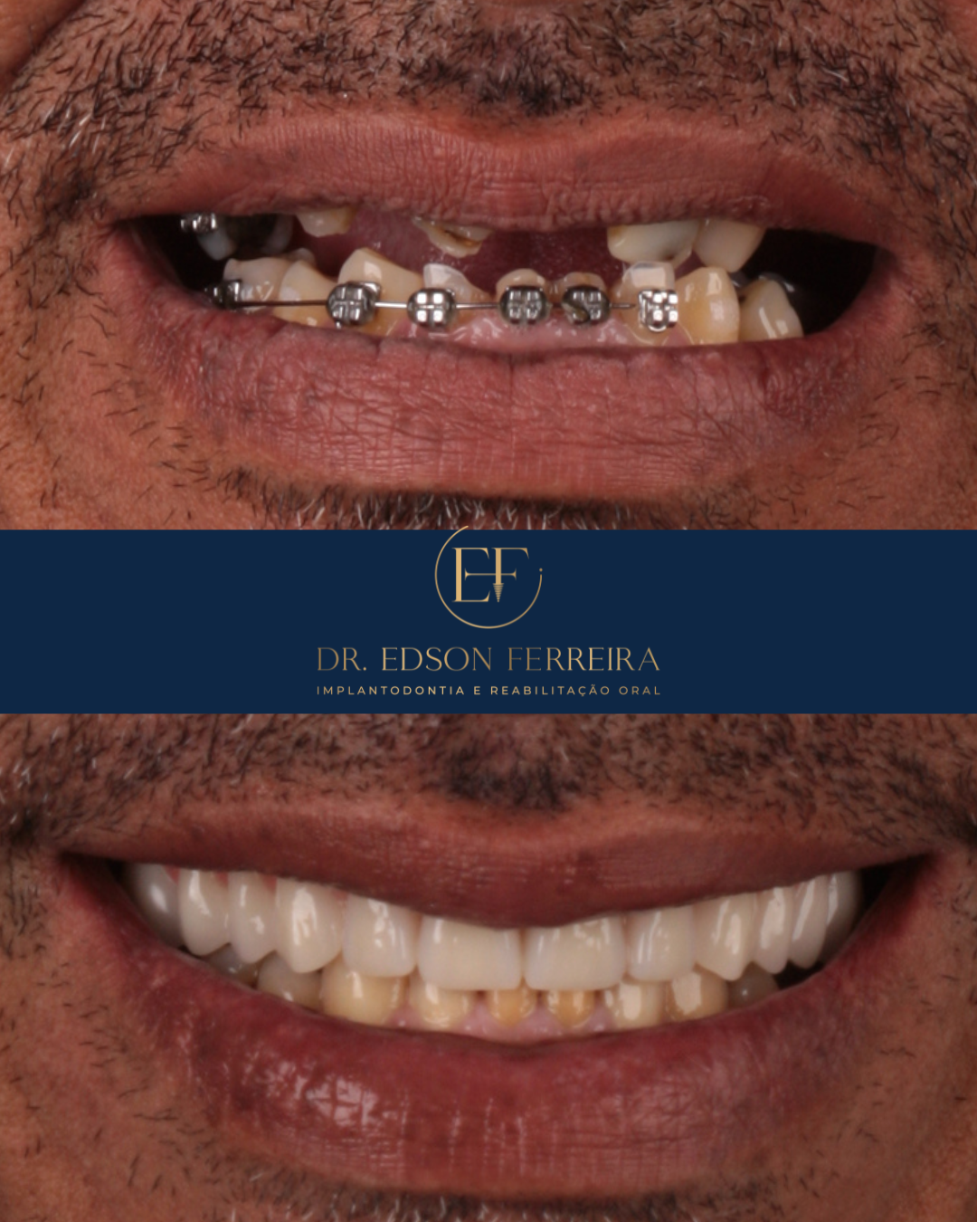 Antes e depois — reabilitação total protocolo fixo, Dr. Edson Ferreira implantodontista Teresina